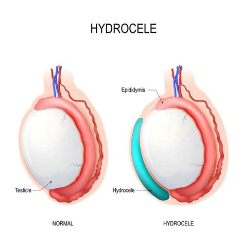 Hydrocele Doctor in Kolkata | Best Treatment for Hydrocele