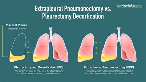 Pleural Mesothelioma and EPP Treatment Options l EPP vs. PD