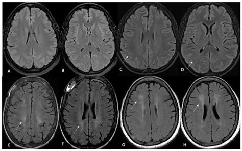 Assessment of Inter-Reader Reliability of Fazekas Scoring on Magnetic ...