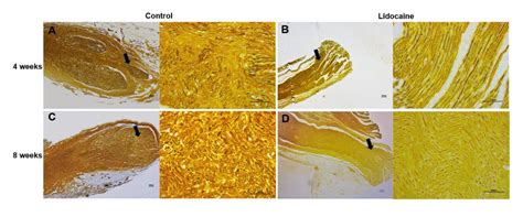 Preventive Effect of Local Lidocaine Administration on the Formation of ...