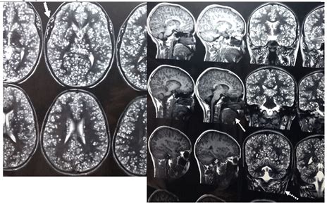 Platelet Transfusion: Diseases and Conditions | Pediatric Oncall