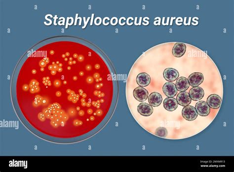 Image result for Staphylococcus Aureus Pathogenicity