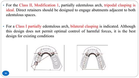 Management of Kennedys Class III Classification | PPTX