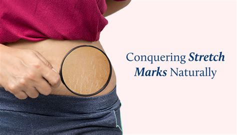 Defeating Stretch Marks with Science and Nature – Blue Nectar