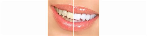 Image result for Teeth Staining Causes