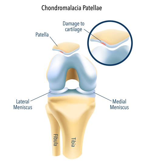 Chondromalacia Patella Treatment
