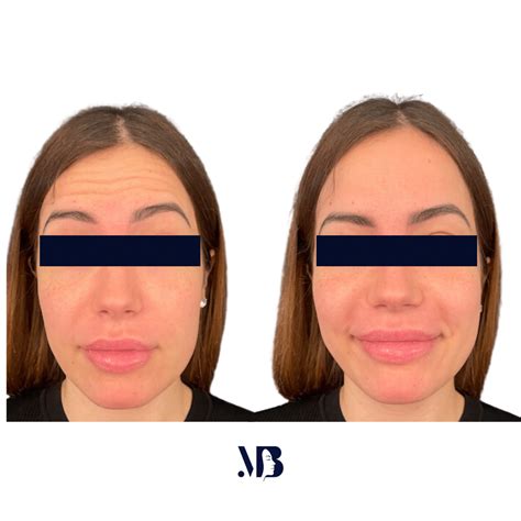 Botox injection for forehead wrinkles in Paris - Doctor Benoilid