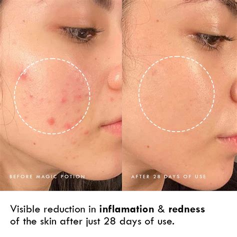 Dull Skin – Auli Lifestyle
