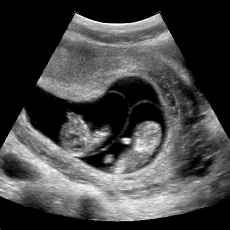 Perinatal Catatonia in Twin Pregnancy case of Unknown Chorionicity and ...