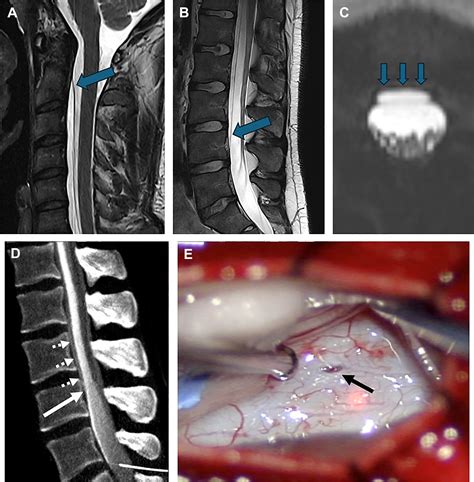 Cerebrospinal Fluid Leaks - Neurosurgery Clinics
