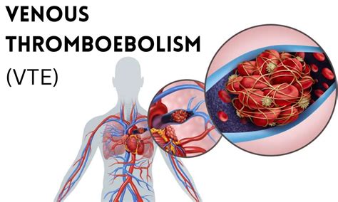 Indefinite anticoagulation fails to improve survival among patients ...