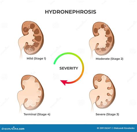 Four Stages of Kidney Hydronephrosis. Vector Illustration of the Mild ...
