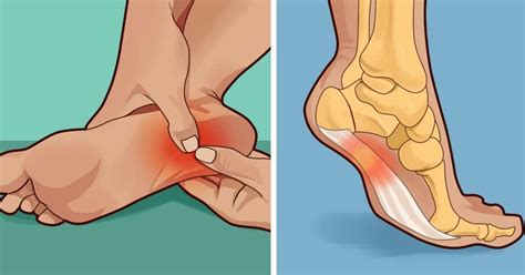 How to treat and prevent plantar fasciitis at home - small ideas