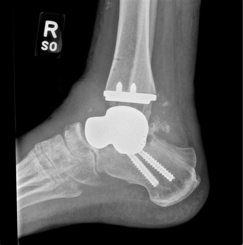 Dr. Toussaint uses 3D printing technology for total talus and ankle replacement surgery