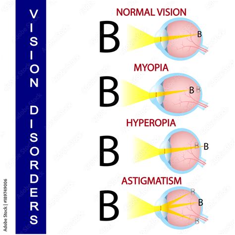 Image result for Types of Vision Problems