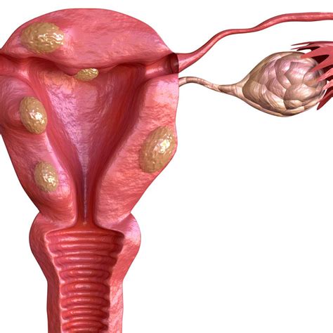 Can Uterine Fibroids Cause Back Pain? | National Vascular Physicians