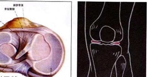 保护膝关节的方法 4项措施保护膝关节_第二人生