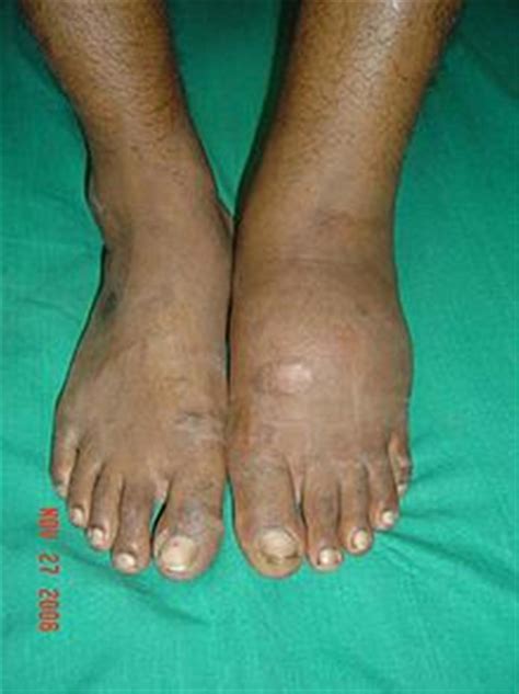 Diabetic Charcot Neuropathy - Foot & Ankle - Orthobullets