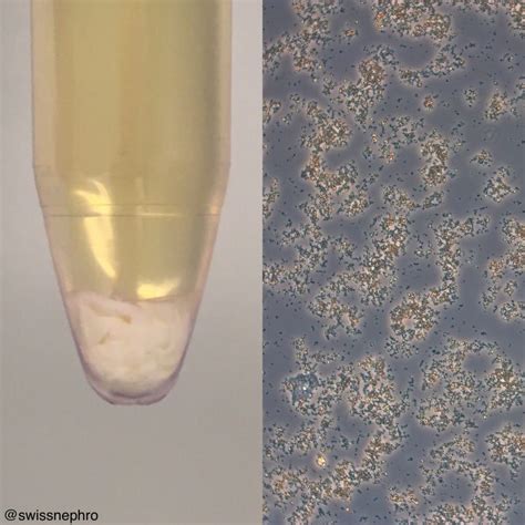 The Best 25 White Specks In Urine - greatmakepic