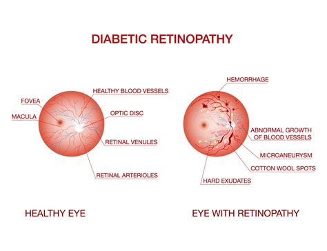 Diabetic retinopathy specialist in Mumbai |Dr Anurag Agarwal