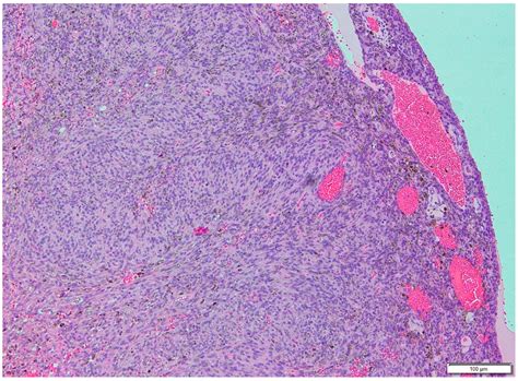 Angiomatoid Fibrous Histiocytoma Initially Misdiagnosed as ...