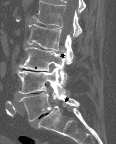 Facet Joint Hypertrophy Mri at Marcus Hanger blog
