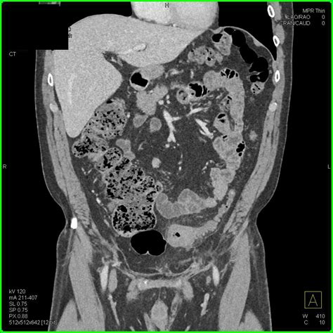 Diverticulitis Sigmoid Colon - Colon Case Studies - CTisus CT Scanning