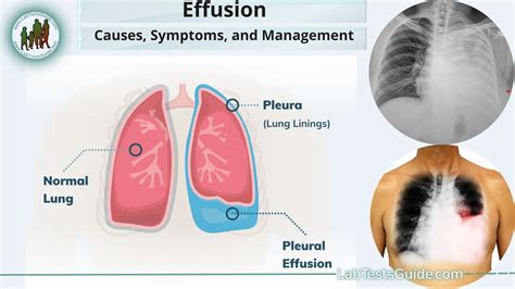 9 Pleural Effusion Causes Symptoms Treatment Prognosis