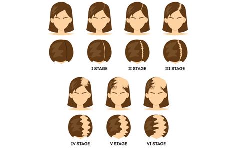 The Link Between Testosterone And Hair Loss In Men And Women – SkinKraft