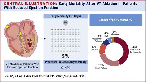 Ventricular Tachycardia Causes Team Management Of The Ventricular