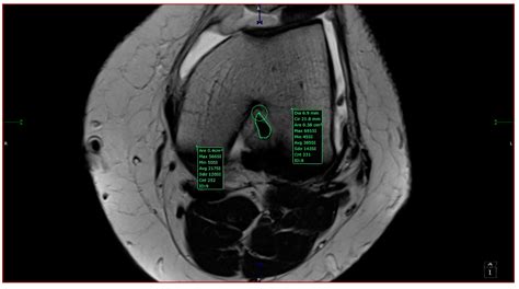 Anterior Intercondylar Notch Geometry in Relation to the Native ...