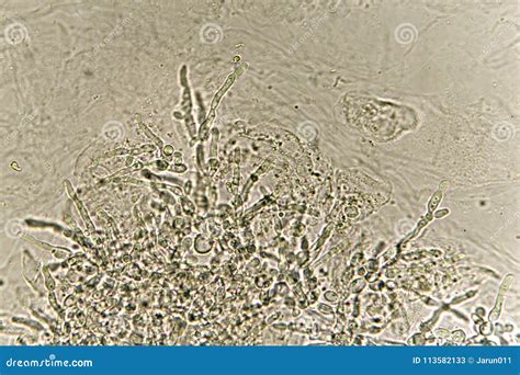 Pseudohyphae and Budding Yeast Cells in Urine Stock Image - Image of ...