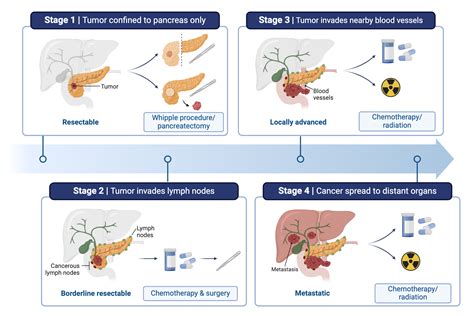 Pancreatic Cancer Staging