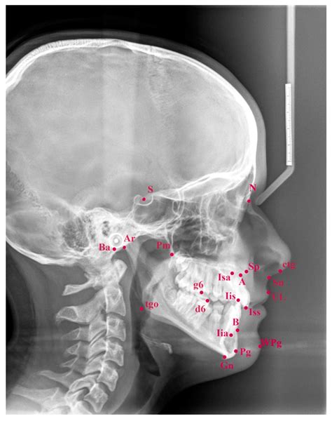 Craniofacial Cephalometric Morphology in Polish Adolescents with Cleft ...