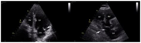 Mitral Annular Calcification and Thromboembolic Risk