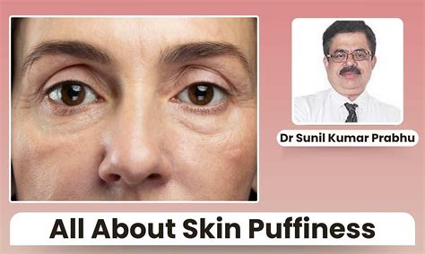 Why Your Skin Looks Puffy? Common Causes and Solutions - Dr Sunil Kumar ...