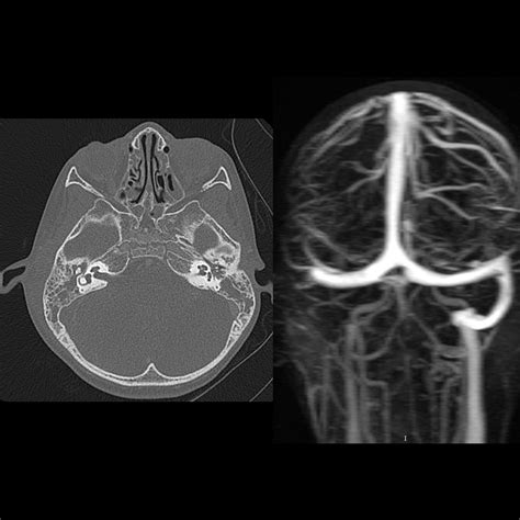 Superior Sagittal Sinus Thrombosis