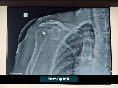 Arthroscopic Shoulder Surgery Shave Bone at Faye Garcia blog