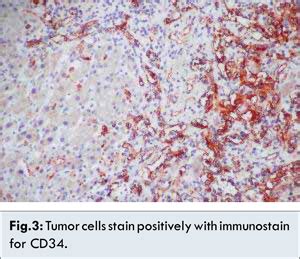 Living Donor Liver Transplantation To Primary Sarcoma of the Liver