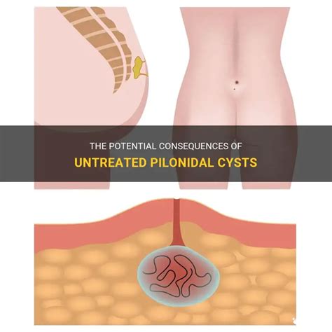 The Potential Consequences Of Untreated Pilonidal Cysts | MedShun