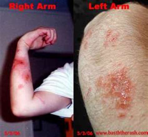 Top 95+ Pictures Pictures Of Oak Mite Bites Stunning