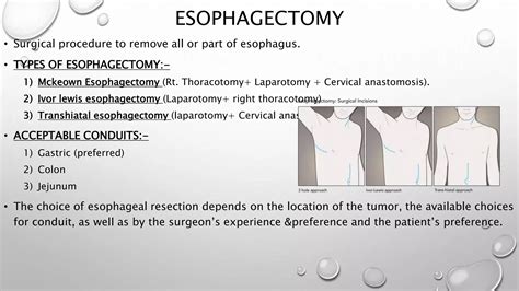 Ivor lewis esophagectomy | PPTX