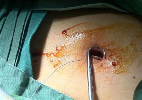 腹腔镜胆囊切除术 腹腔镜胆囊切除术,是怎样的手术