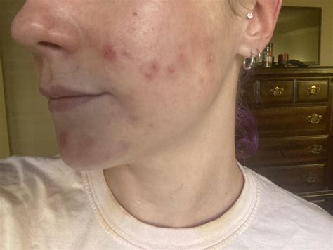 Image result for Loud Exploding Zit