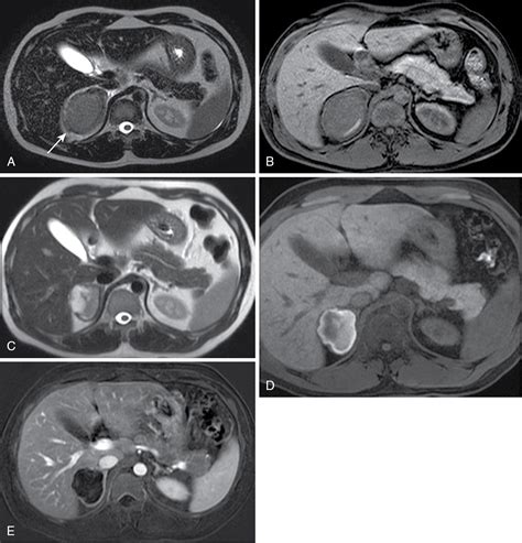 Adrenal gland enlargement and nodules | Radiology Key