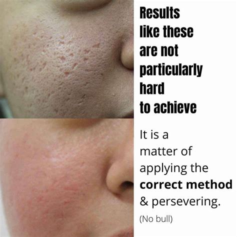 Best Acne Chemical Peels Treatment | Dr Davin Lim