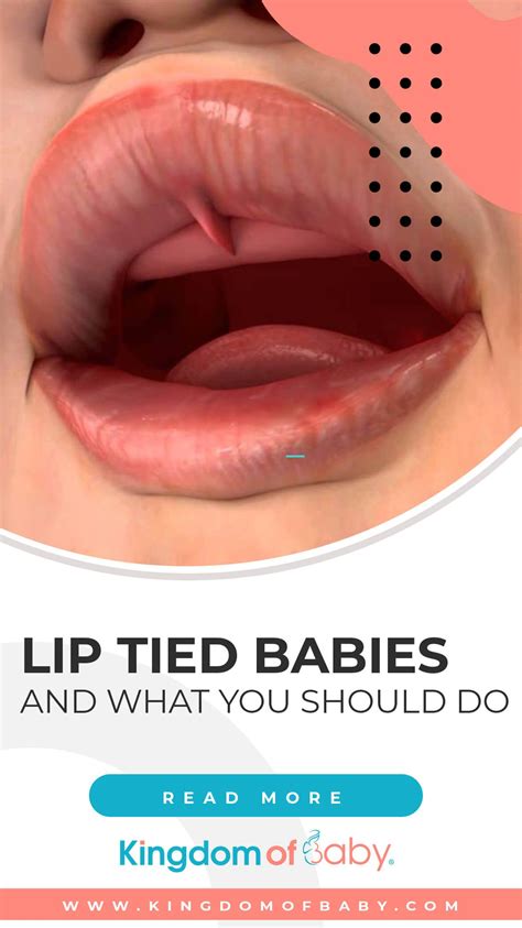 Breastfeeding problems and how to properly identify a tongue and lip tie – Artofit