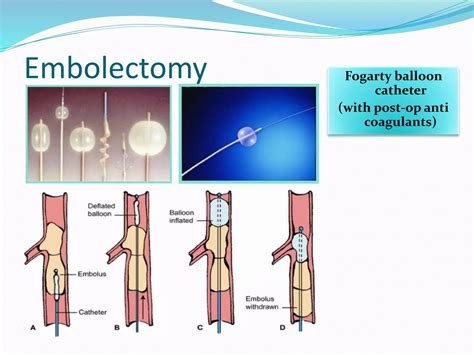 LIMB ISCHEMIA-ACUTE.pptx