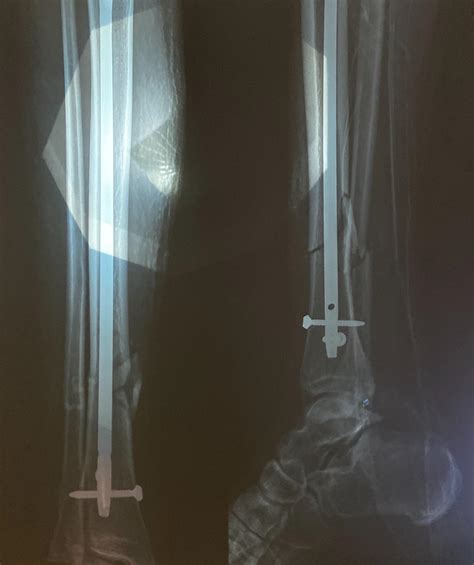 Broken Tib/Fib with a titanium rod, two screws below the knee and two above my foot : r/brokenbones