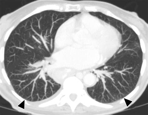 Right Ventricle Function Assessment by MDCT | AJR